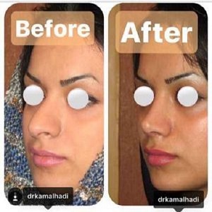 تحقیق درباره بهترین جراح بینی در تهران