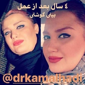 هزینه عمل انواع بینی