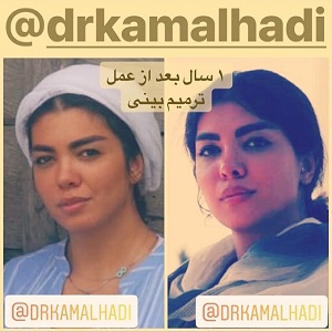هزینه عمل ترمیم بینی