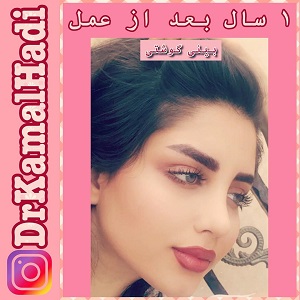 سوالات رایج درباره جراحی بینی
