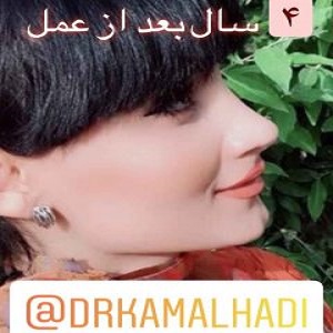 سوالات رایج درباره جراحی بینی