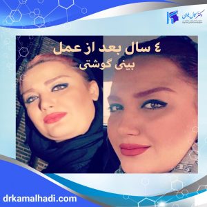 هزینه جراحی بینی